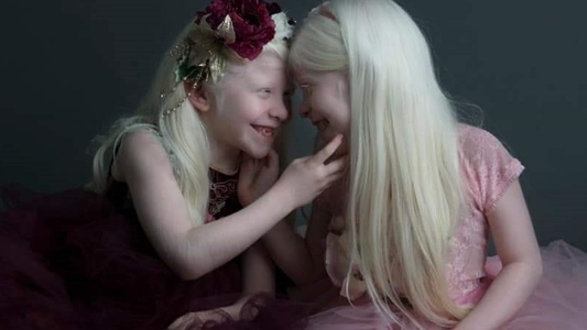 Albinos: las mellizas Valen y Mailén, su historia inspiradora y la lucha contra un tabú