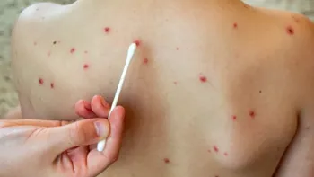 Alerta sanitaria en Argentina por casos de sarampión: quiénes deben controlarse y cuáles son los síntomas