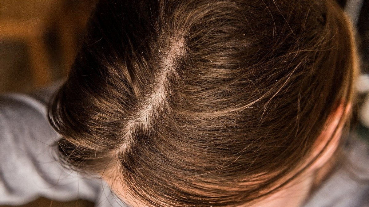 C&oacute;mo eliminar la caspa con elementos que ten&eacute;s en casa: todo natural