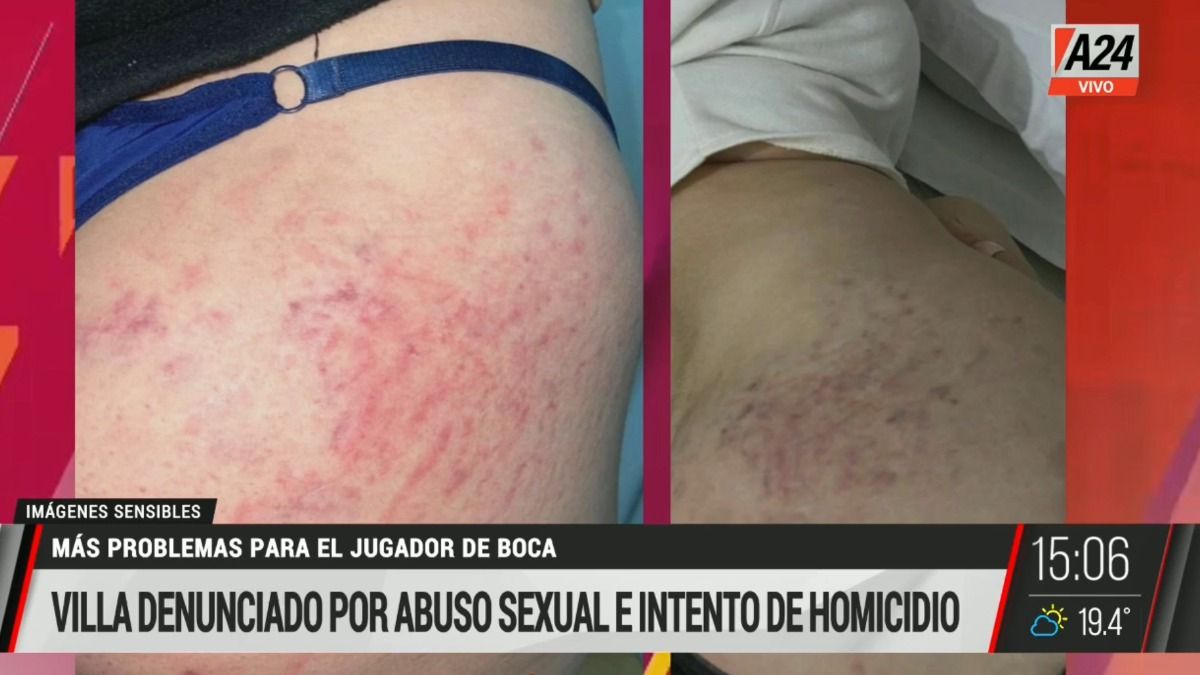 Las imágenes de las lesiones que le habría causado Sebastián Villa a una joven que lo denunció por intento de homicidio y violación. (Captura)