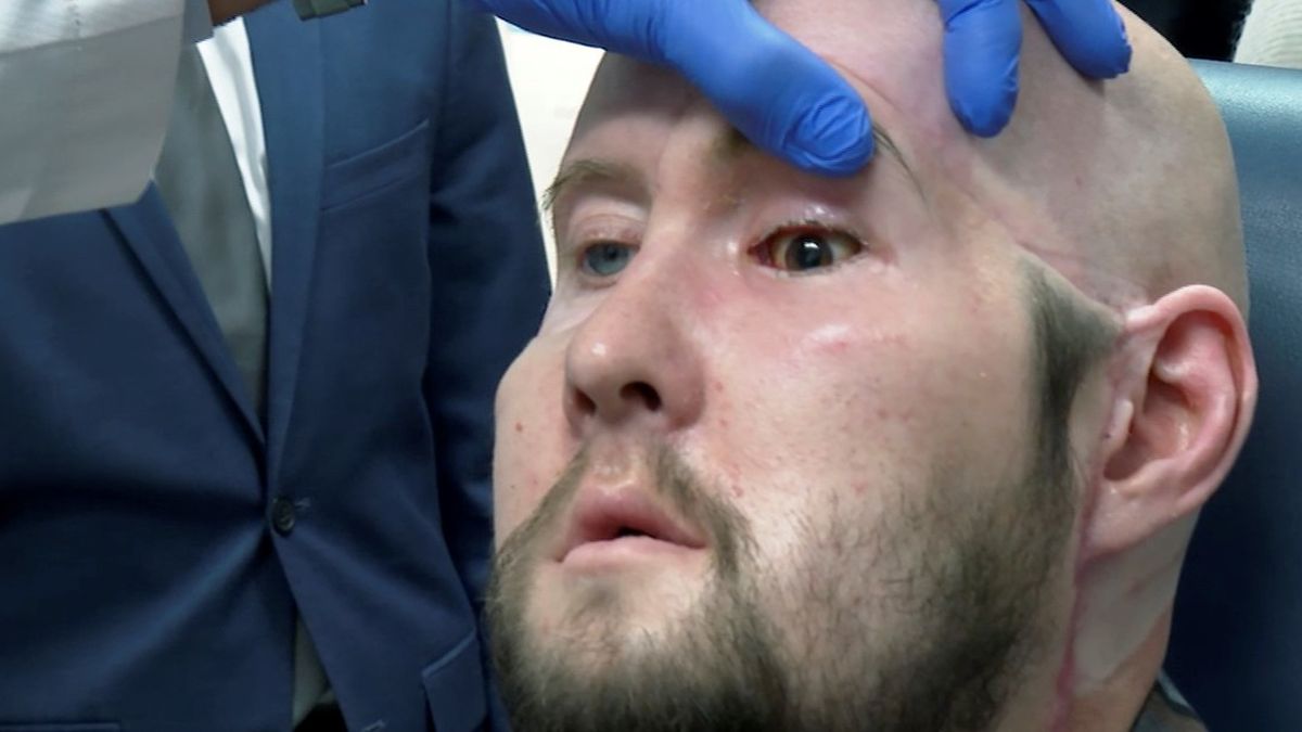 Avance médico: realizan en Estados Unidos el primer trasplante de un ojo entero. (AP)