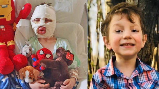 Nene de 6 años sufrió quemaduras tras el ataque de otros chicos con una pelota de tenis en llamas