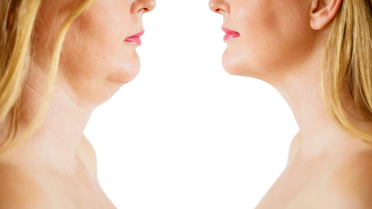 Cómo eliminar la papada de forma definitiva