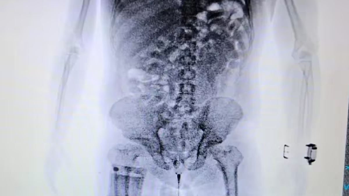 Detuvieron un hombre que intentaba viajar a España con 84 cápsulas de cocaína en su estómago. (Fotos: Télam/AFIP) Detuvieron un hombre que intentaba viajar a España con 84 cápsulas de cocaína en su estómago. (Fotos: Télam/AFIP)