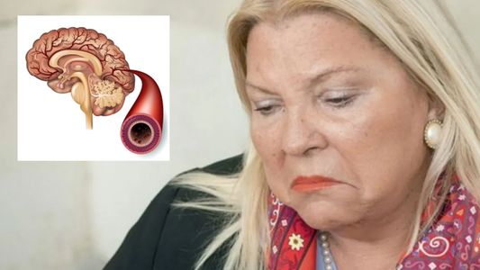 Lilita Carrió sufrió un accidente isquémico transitorio: ¿de qué se trata este tipo de cuadro?