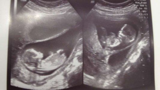 Dos fetos se agarraron a piñas en el útero de la madre y todo quedó grabado en una ecografía